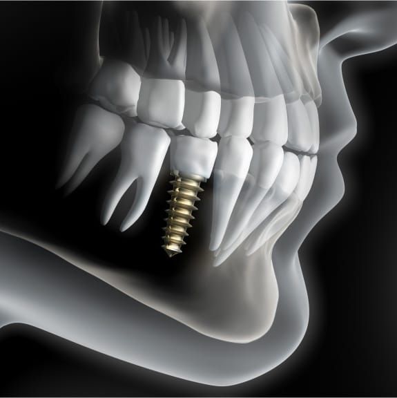 Implantes Dentales