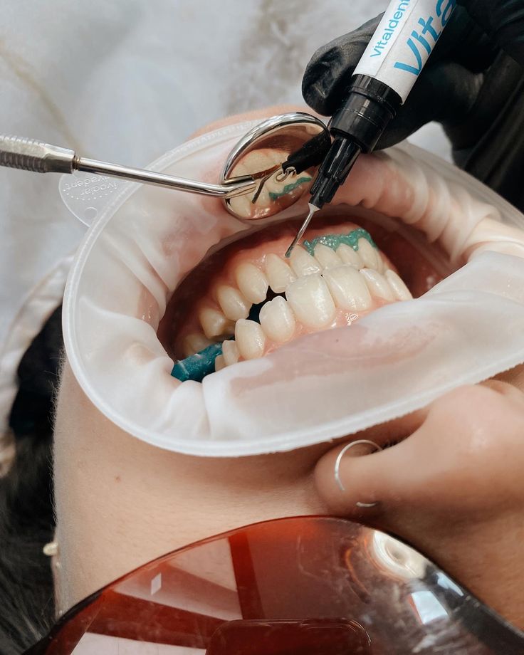 Blanqueamiento Dental
