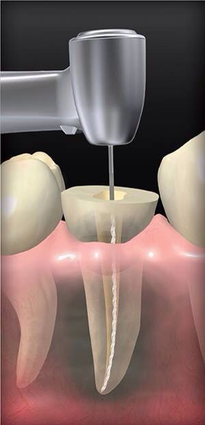 Endodoncia